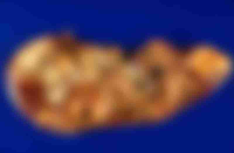 Carcinoid Liver